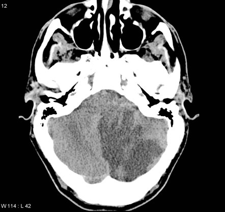 PICA infarct with hydrocephalus, Radiology Case