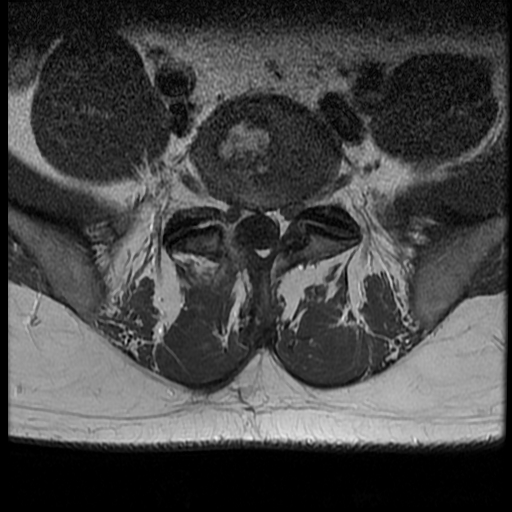 Postoperative Spondylodiscitis | Image | Radiopaedia.org