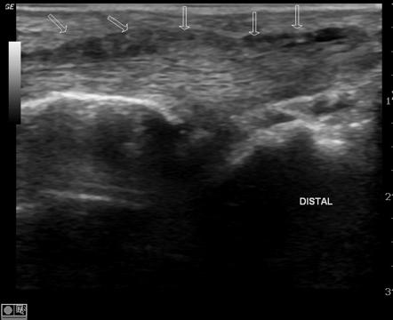 De Quervain's Ultrasound