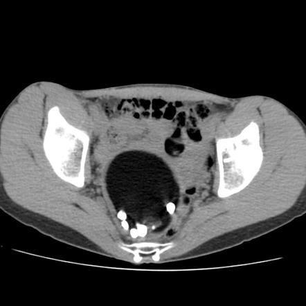 grapefruit size ovarian dermoid cyst