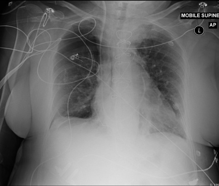 Pneumothorax and pneumomediastinum on supine chest x-ray | Radiology ...