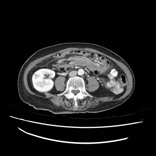 Colocolic intussusception | Image | Radiopaedia.org