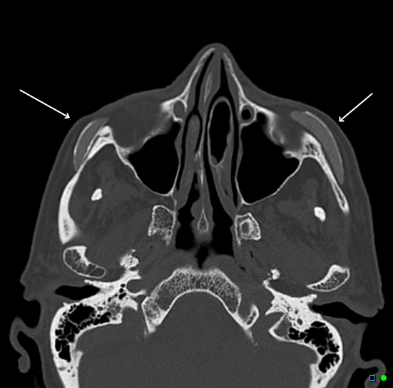 Silicone cheek implants | Radiology Case | Radiopaedia.org