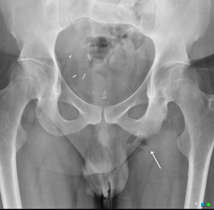 pressure sore buttock ulcer osteomyelitis chronic causing acute radiopaedia elbow ray murphy injuries frontal