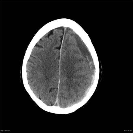 Extradural Haematoma Vs Subdural Haematoma Radiology Reference