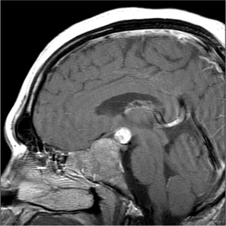 Pituitary macroadenoma - medically treated | Radiology Case ...