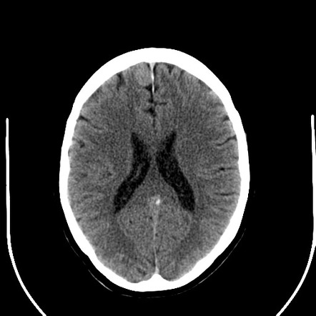 Meningioma with radiosurgery | Radiology Case | Radiopaedia.org