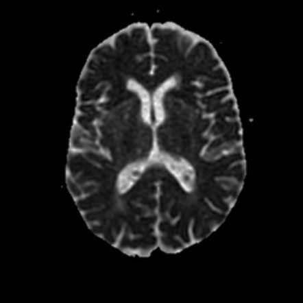 gamma knife parafalcine meningioma complications after radiopaedia adc axial