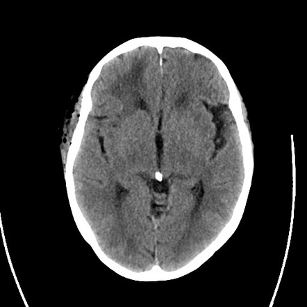 meningioma complications parafalcine radiopaedia