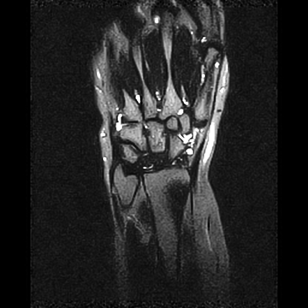 Avascular necrosis of the lunate bone - Kienbock's disease | Image ...