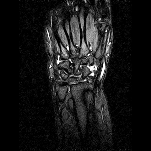 Avascular necrosis of the lunate bone - Kienbock's disease | Image ...