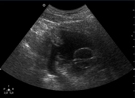 Intraperitoneal bladder rupture | Radiology Case | Radiopaedia.org