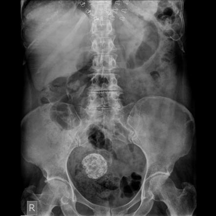 Uterine leiomyoma | Radiology Reference Article | Radiopaedia.org