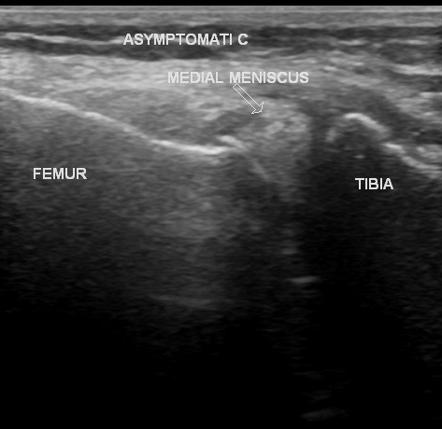 Extruded meniscus | Image | Radiopaedia.org