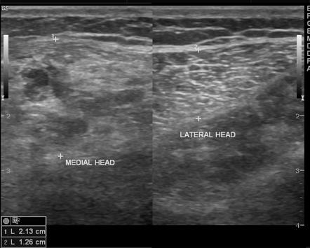 Haemengioma of medial head of gastrocnemus muscle | Radiology Case ...