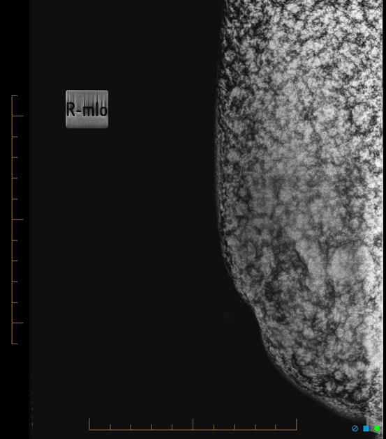 Silicone injection and insertion cosmetic Radiology Reference