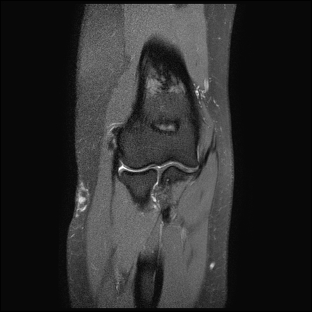 Elbow Common Extensor Tendon Tear