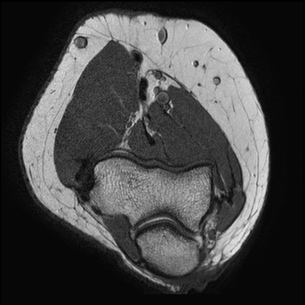 Elbow common extensor origin partial tear | Image | Radiopaedia.org