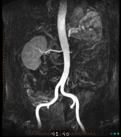 Renal angiogram - MR angiography | Image | Radiopaedia.org