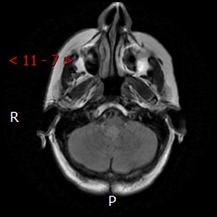 Posterior fossa ependymoma | Image | Radiopaedia.org