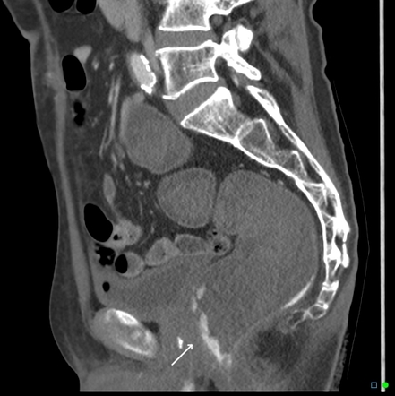 Lower gastrointestinal bleeding (differential) | Radiology Reference Article | Radiopaedia.org