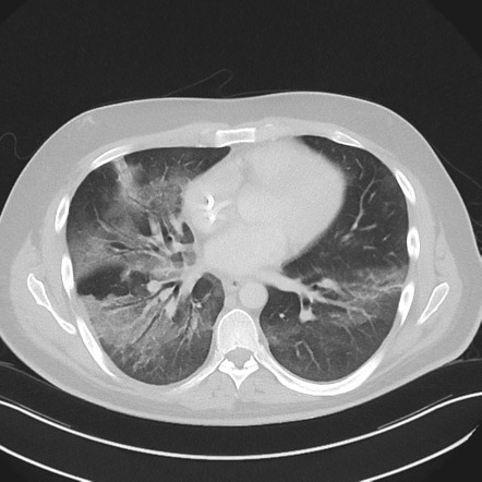 Diffuse Ground-glass Opacification | Radiology Reference Article ...