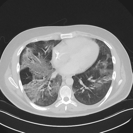 CMV - pneumonia as related to Chest Pain - Pictures