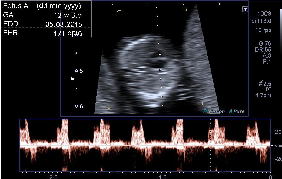 Absent ductus venosus | Image | Radiopaedia.org