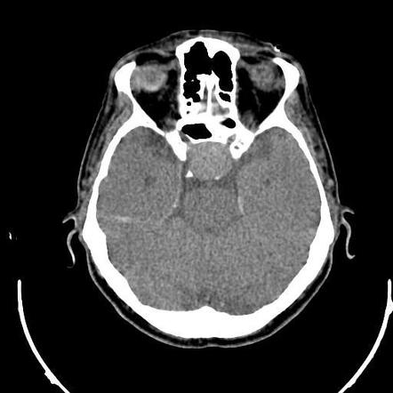 Pituitary Macroadenoma | Image | Radiopaedia.org