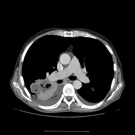 Lung abscess | Radiology Reference Article | Radiopaedia.org