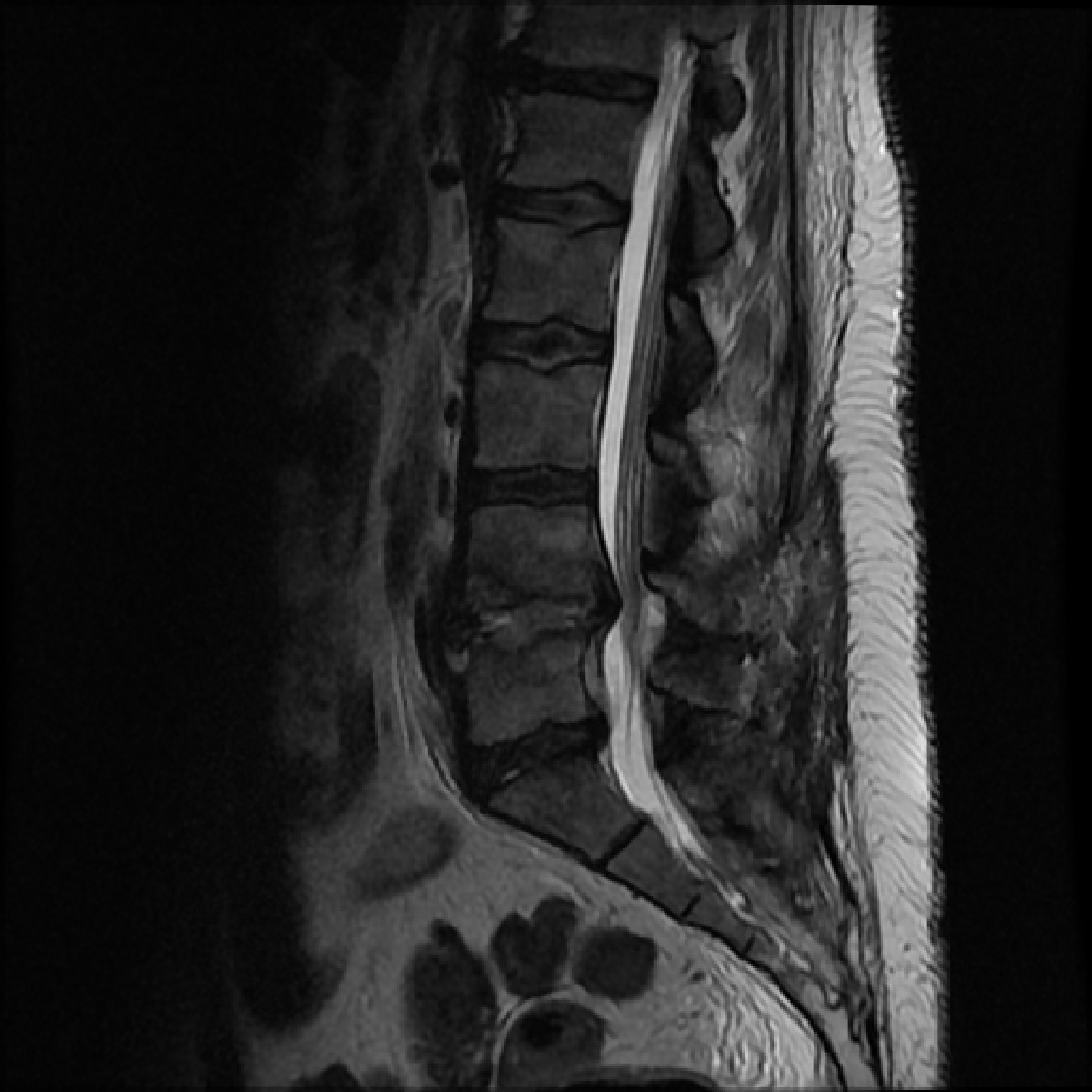 Spondylodiscitis - post surgery | Image | Radiopaedia.org