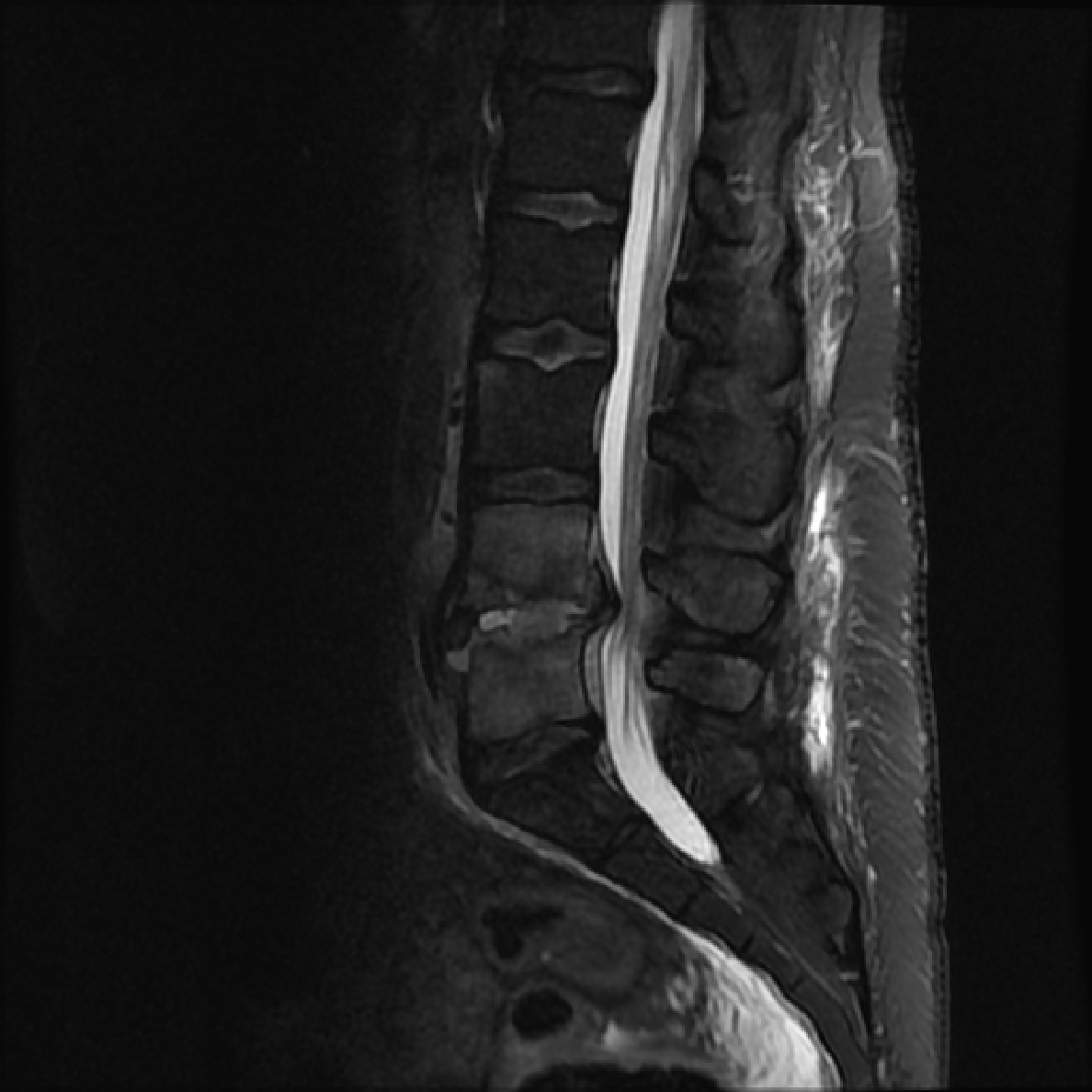 Spondylodiscitis - Post Surgery | Image | Radiopaedia.org