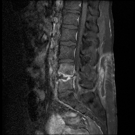 Spondylodiscitis - Post Surgery | Radiology Case | Radiopaedia.org