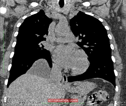 Pericardial cyst | Image | Radiopaedia.org