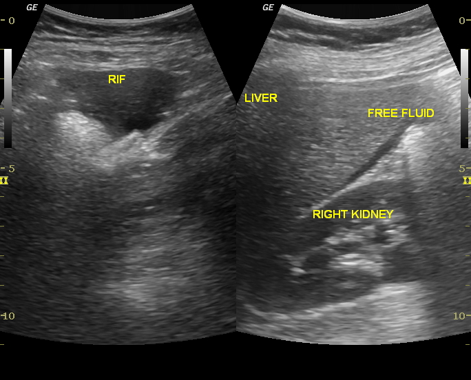 Ruptured haemorragic corpus luteal cyst | Image | Radiopaedia.org