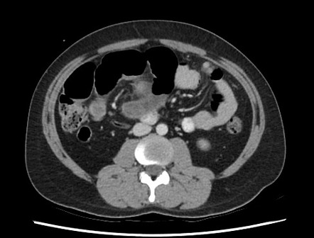 Internal hernia | Radiology Reference Article | Radiopaedia.org