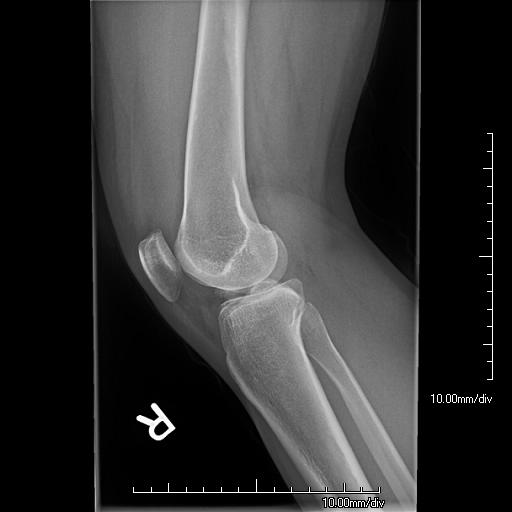 Segond fracture with tibial spine avulsion | Image | Radiopaedia.org