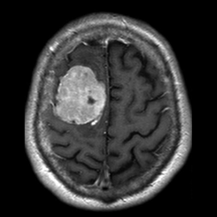 Tumour-to-tumour metastasis | Radiology Reference Article | Radiopaedia.org