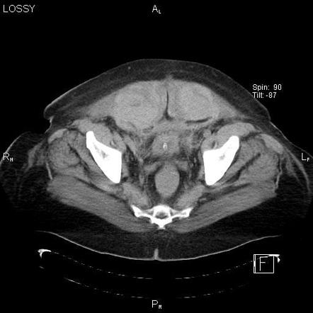 Rectus Sheath Hematoma Radiology Reference Article My Xxx Hot Girl