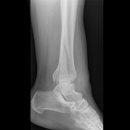 Trimalleolar ankle fracture | Image | Radiopaedia.org