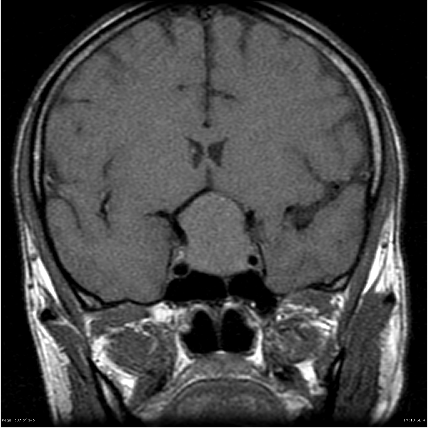 Pituitary Macroadenoma | Image | Radiopaedia.org