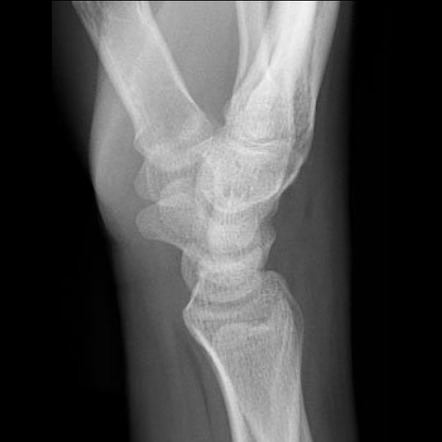 Wrist radiograph (summary approach) | Radiology Reference Article ...