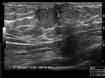 The Radiology Assistant : Pathology of the Male Breast