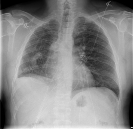 Scimitar syndrome (lungs) | Radiology Reference Article | Radiopaedia.org