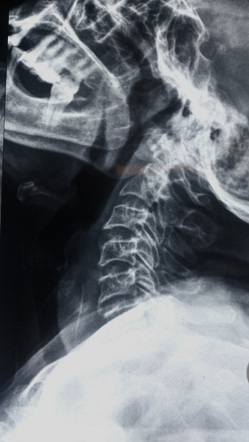 Ingested bone | Radiology Case | Radiopaedia.org