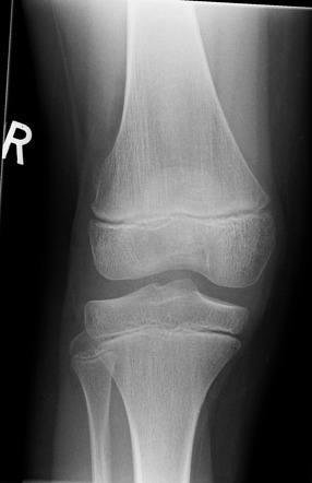 Normal patella - secondary ossification center | Image | Radiopaedia.org