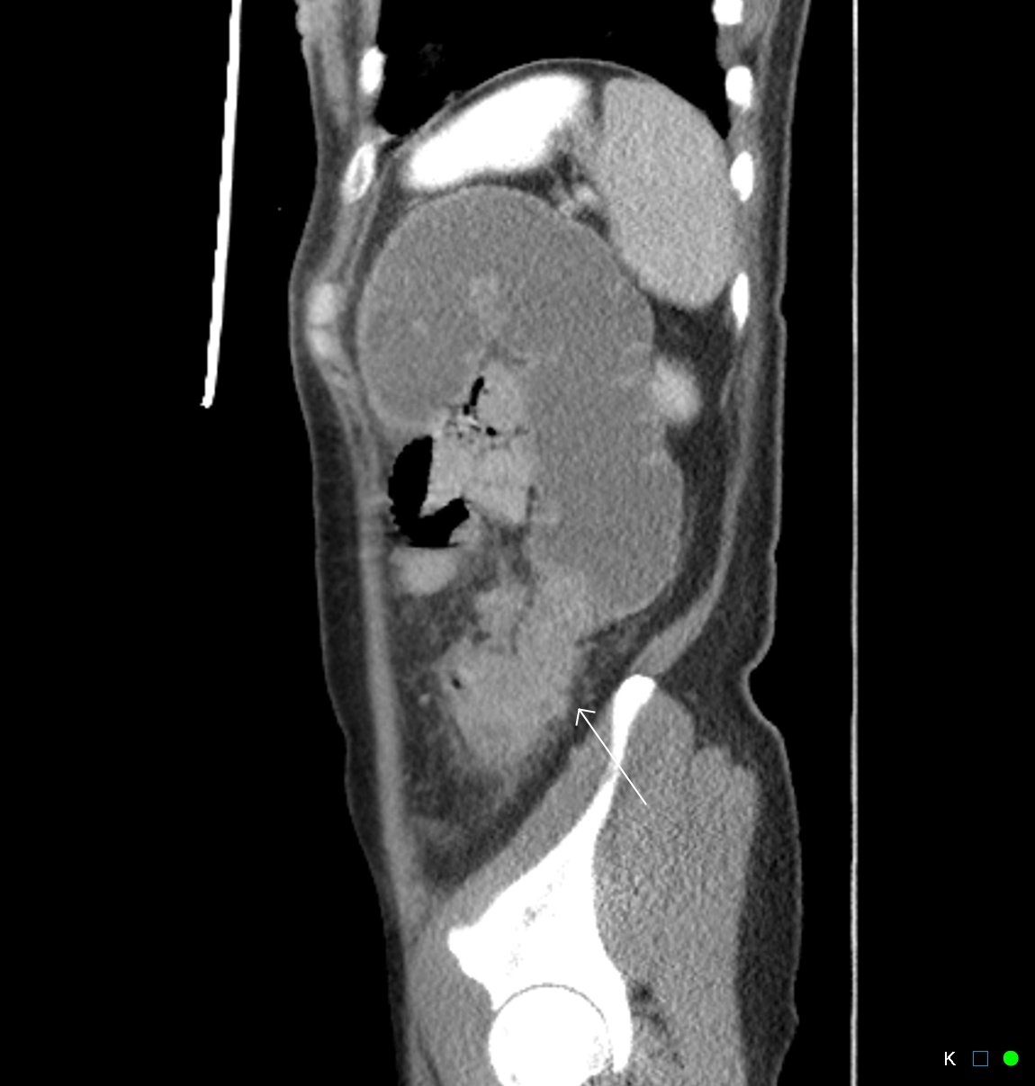 What Is Primary Malignant Neoplasm Of Colon