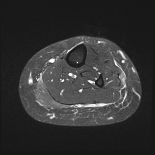 Morphea Localized Scleroderma Image