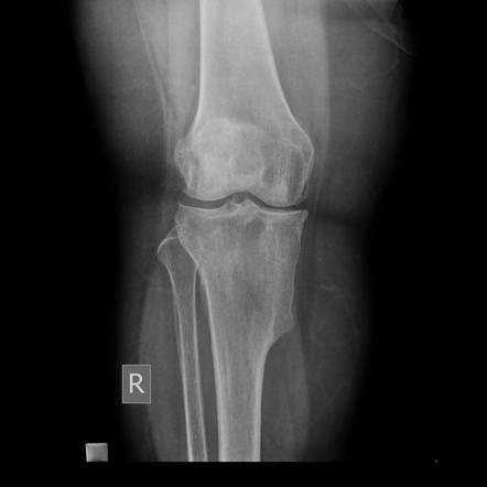 Sessile exotosis - tibia | Radiology Case | Radiopaedia.org