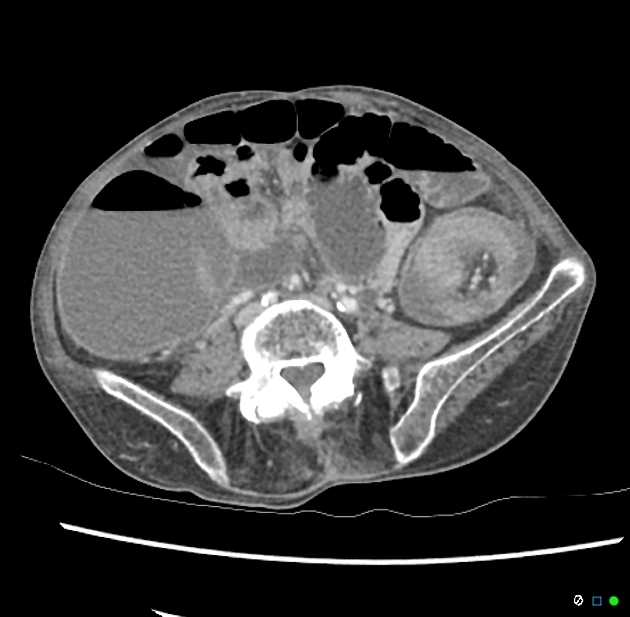 Colo Colonic Intussusception Nicholaslack 